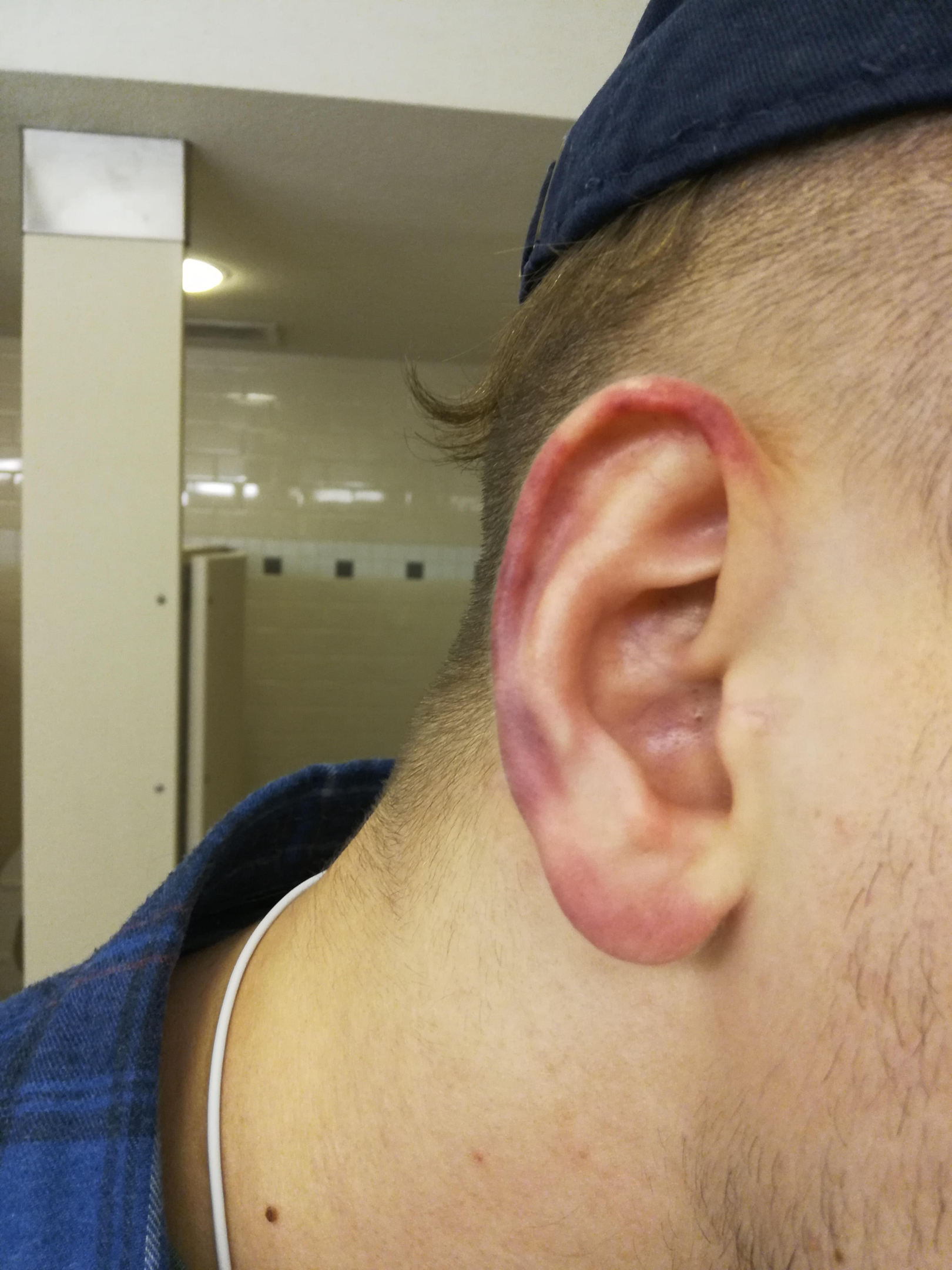 draining cauliflower ear at home